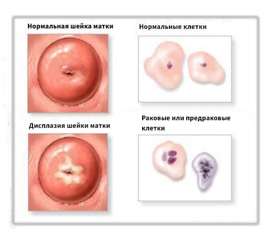Клетки при дисплазии шейки матки.