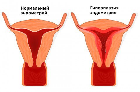 Что такое гиперплазия?