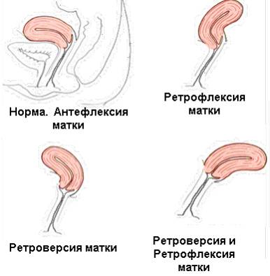 Ретрофлексия матки