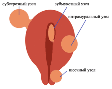 Субсерозный узел