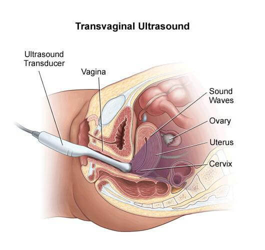Трансвагинальное УЗИ