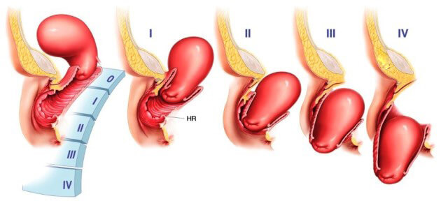 Степени снижения задней стенки матки