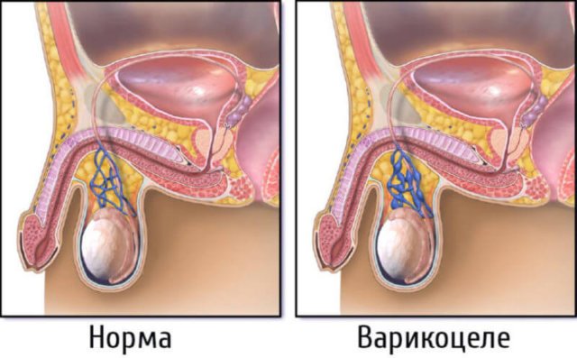 Варикоцеле