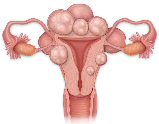 Фибромы матки